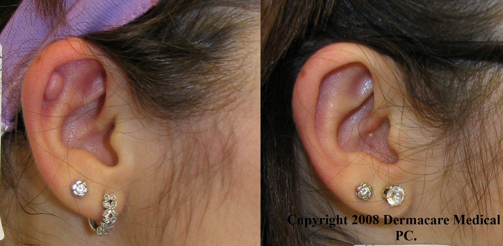 New York keloid removal and scar treatment and improvement