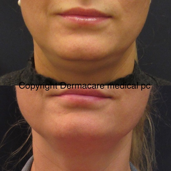 kybella before after chin