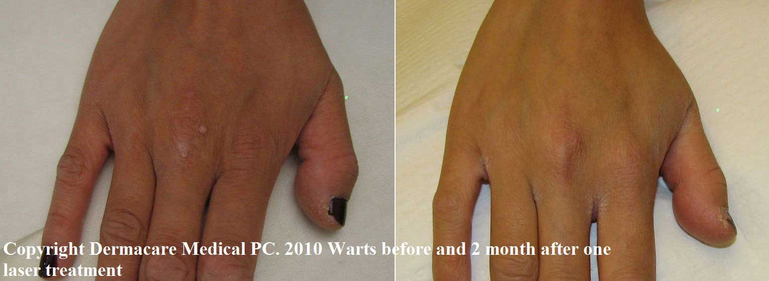 hand wart before and after laser treatment