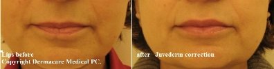 Lips enhancement with juvederm