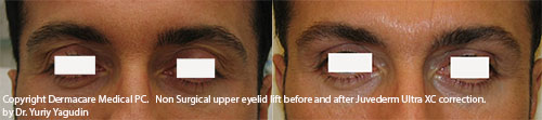 upper eyelid lift