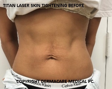 Titan laser skin tightening before