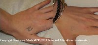 Tattoo before and after Laser treatment hand Palomar Q Yag 5