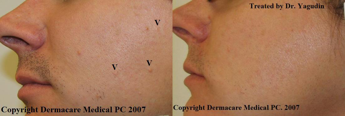 Sebaceous Hyperplasia Before And After Photos