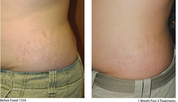 Fraxel re:store stretch marks before and after