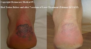 heel tattoo before and after laser tattoo removal