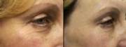 Before and after Omilux combination therapy showing reduction of fine lines and wrinkles