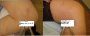 Before and After 1 Laser Vein Treatment