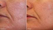 Laser Genesis pore reduction before and after