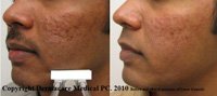 acne scar treatment with laser genesis