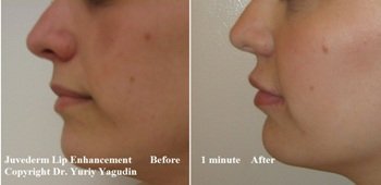 lips before and after juvederm side profile view