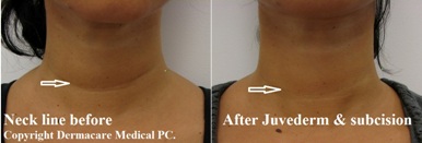 neck line before and after juvederm and subcision