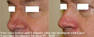 nose veins laser treatment