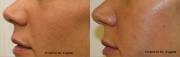 Before and After 4 Laser Genesis Sessions for Texture Improvement