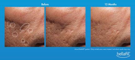 bellafill acne scars treatment
