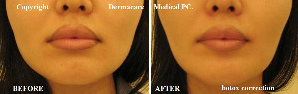 Botox jaw reduction before and after