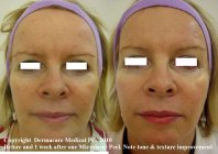 microLaser peel before after