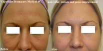 MicroLaser Peel Before After Pores