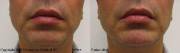 Non-surgical chin augmentation before and after