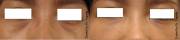 Dark under eyes circles before and after Juvederm 2