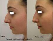 Non surgical nose job with Juvederm