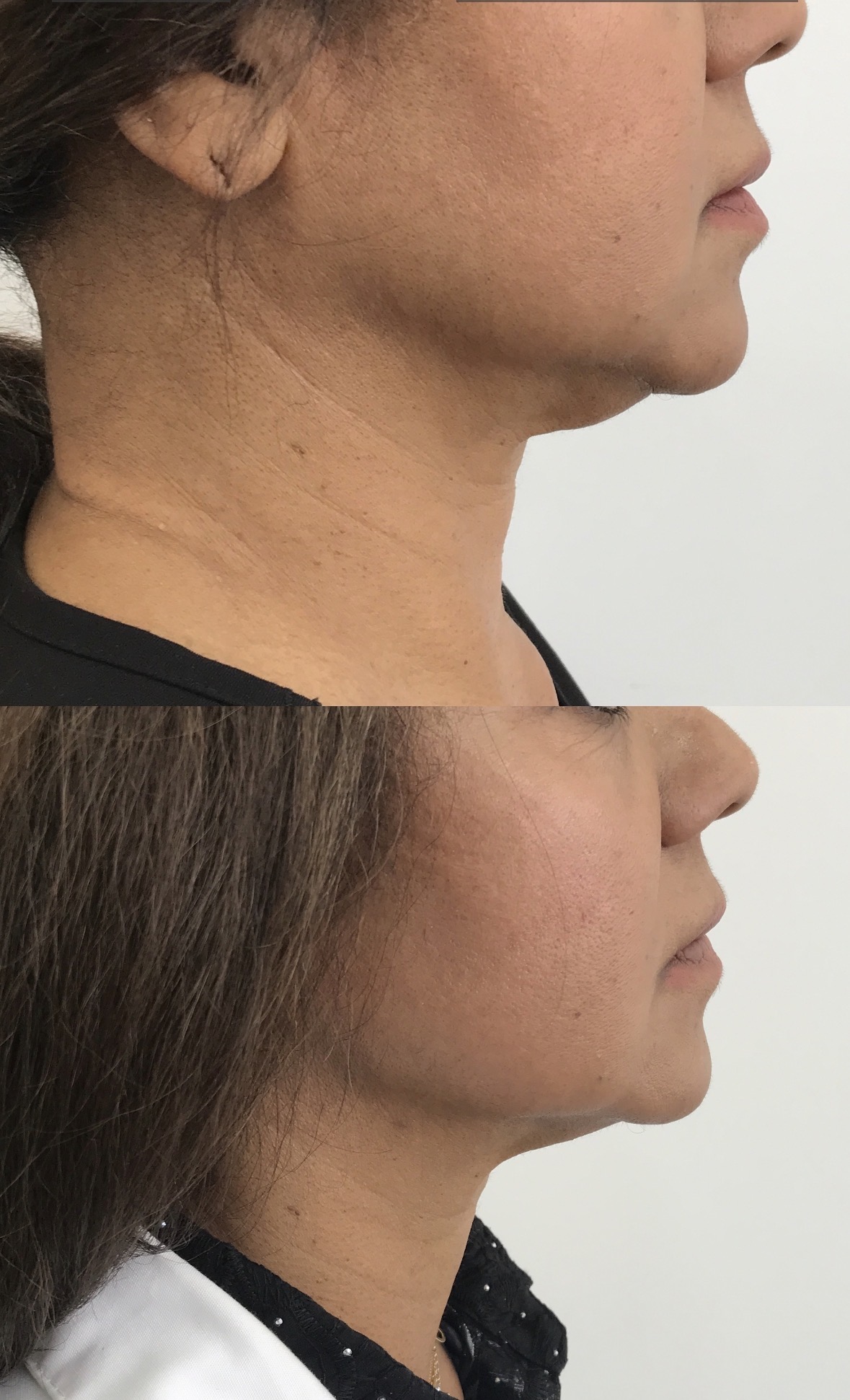Endolift before and after jawline and neck