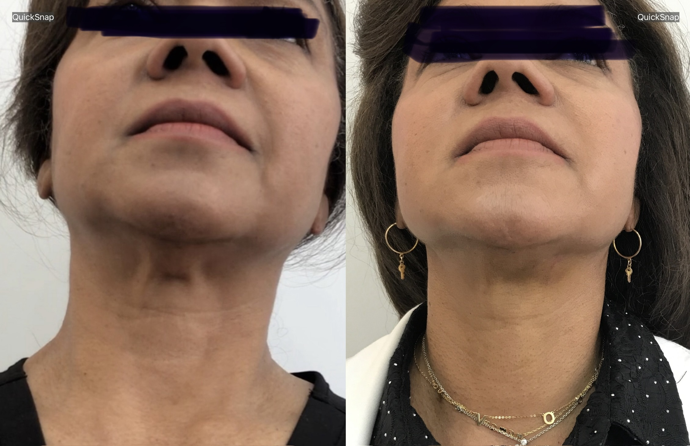 Endolift before and after neck