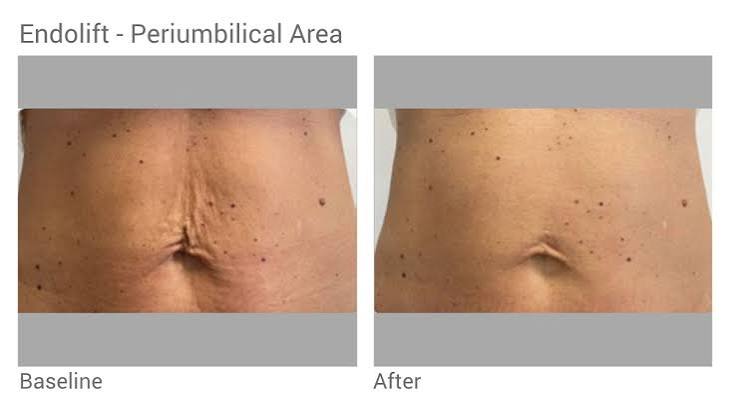 Endolift before and after abdomen
