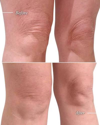 Endolift before and after knees