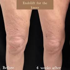 Endolift before and after knees