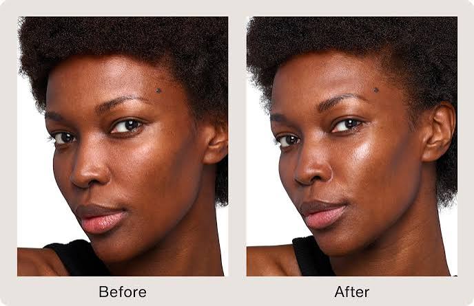 Skinvive by Juvéderm treatment image 1