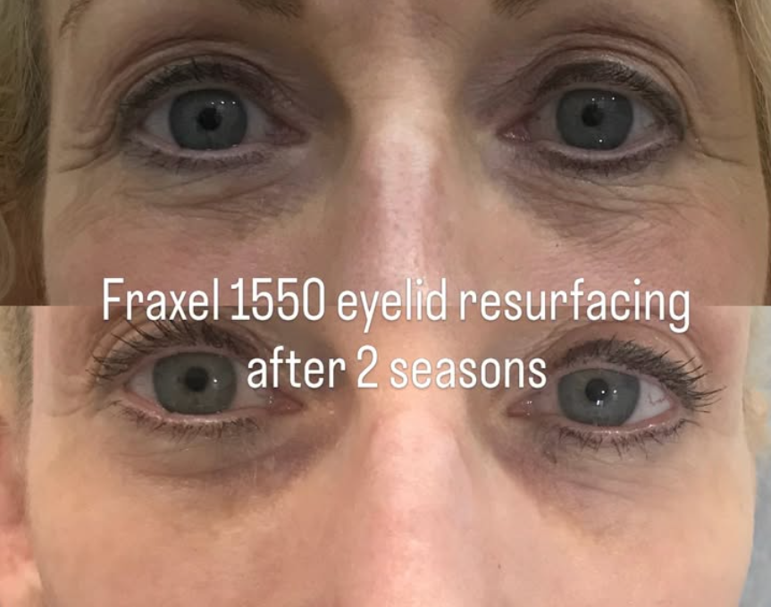 Fraxel eyelid wrinkle treatment result