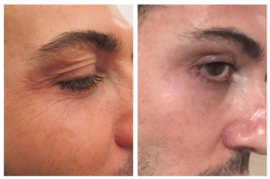 Fraxel eyelid wrinkle treatment result