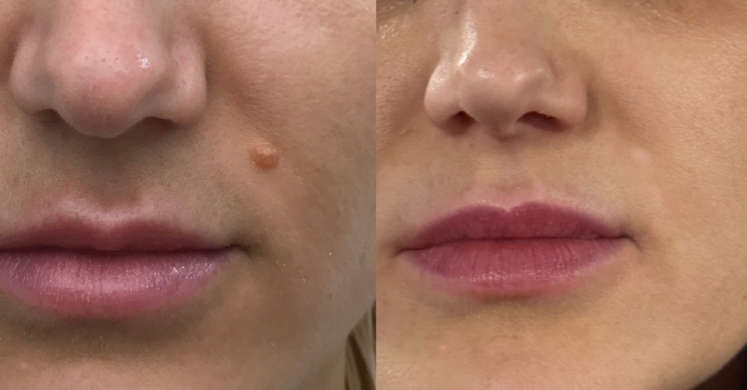 Side-by-side photographs before and after facial mole removal