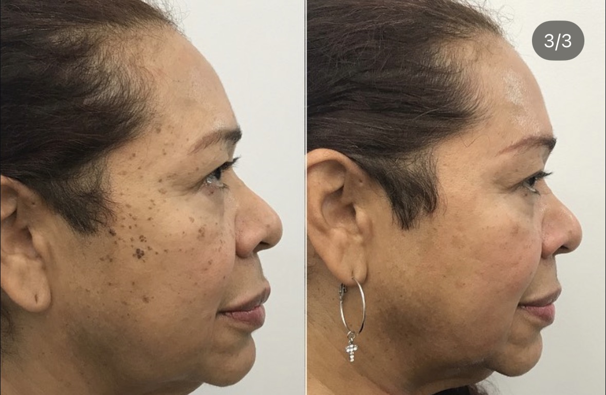 Side view before and after skin treatment
