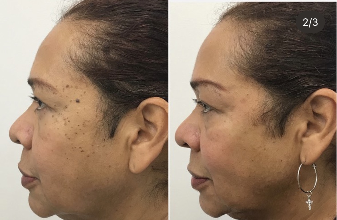 Opposite side view before and after skin treatment