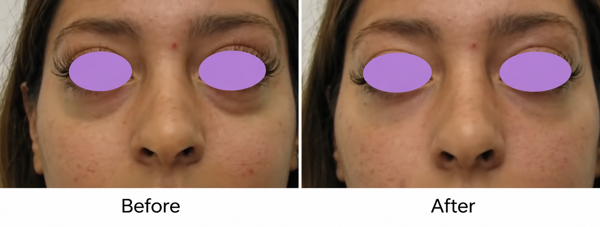 Under-eye treatment before on left and after on right